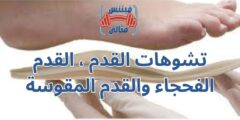تشوهات القدم ، القدم الفحجاء والقدم المقوسة