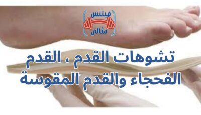 تشوهات القدم ، القدم الفحجاء والقدم المقوسة تشوهات القدم ، القدم الفحجاء والقدم المقوسة