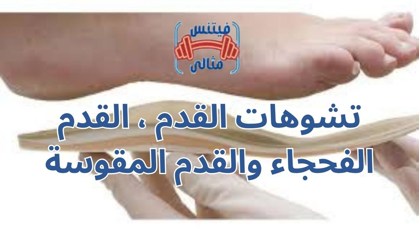 تشوهات القدم ، القدم الفحجاء والقدم المقوسة